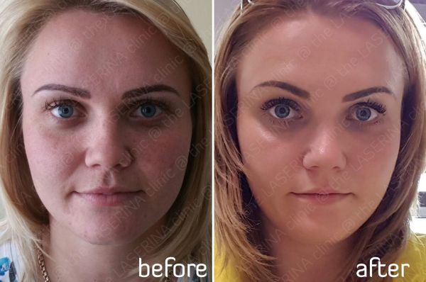 prp therapy, anti-ageing
