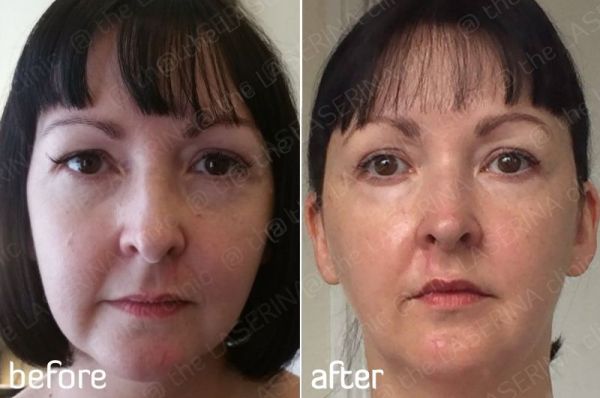 dracula prp therapy