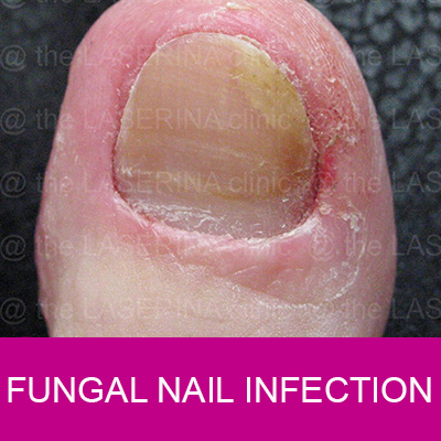 fungal nail infection treatment