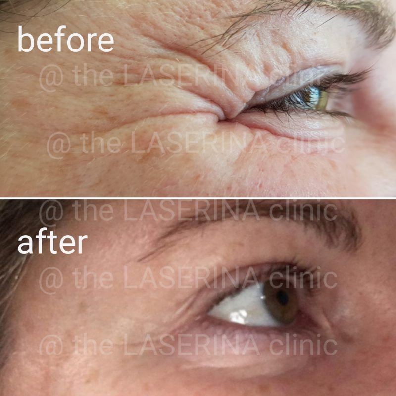 botulinum toxin