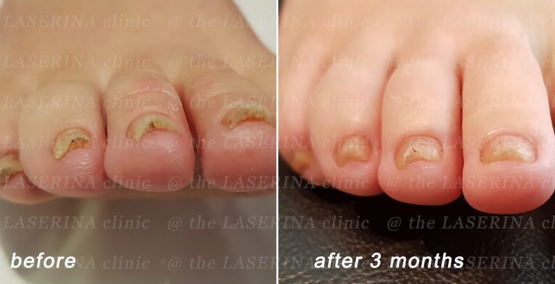 fungal nial infection treatment