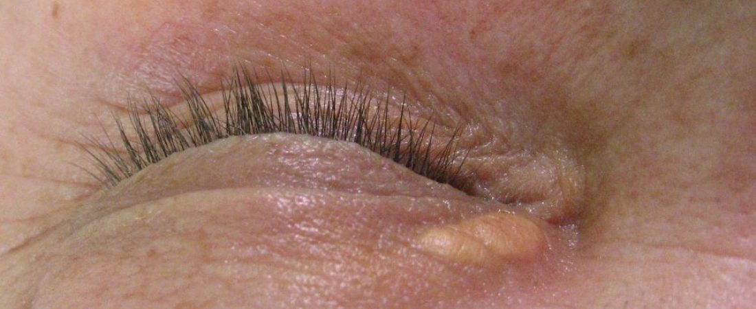 Xanthelasma cause, myths and treatment advantages.