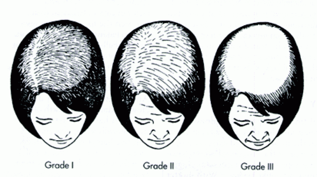 HAIR LOSS, CAUSES AND TREATMENTS – part 1