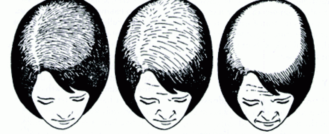 HAIR LOSS, CAUSES AND TREATMENTS – part 1
