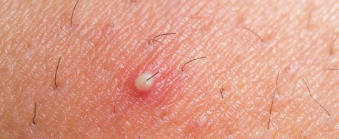 INGROWN HAIRS, CAUSE and TREATMENT.
