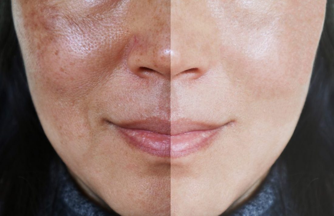 UNWANTED PIGMENTATION – MELASMA TREATMENT