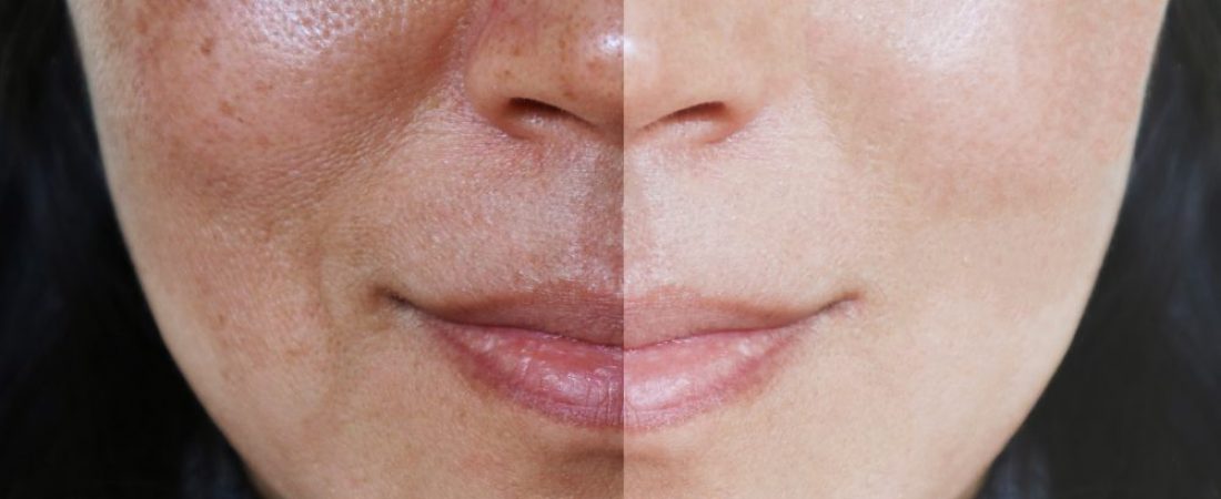 UNWANTED PIGMENTATION – MELASMA TREATMENT
