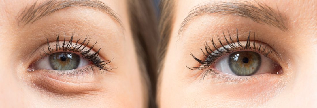 DARK CIRCLES TREATMENT