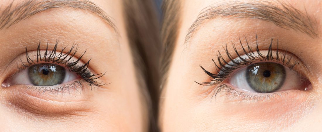 DARK CIRCLES TREATMENT