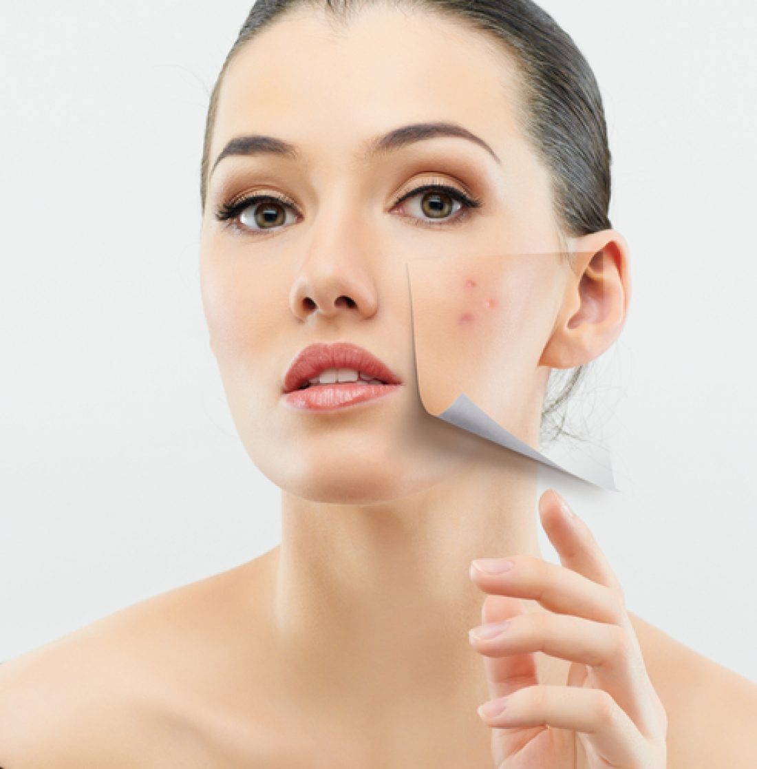 Adult acne: types, causes, myths and treatments