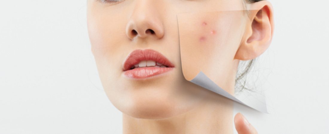 Adult acne: types, causes, myths and treatments